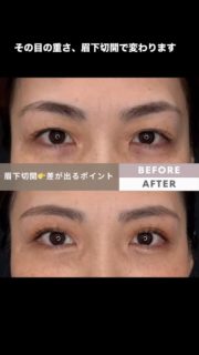 【眉下切開で自然に若々しい目元へ】

こんにちは、AZABU AMOUR CLINICの院長　荻島です。
形成外科専門医、美容外科医として、年間200件以上の眉下切開を行っています。

眉下切開（眉下リフト）は、
眉毛のすぐ下の皮膚を切除することで
まぶたの重さ・たるみを改善する手術です。

✅ こんなお悩みに向いています
・まぶたが重くて目が開きにくい
・おでこや眉に力を入れて目を開けている
・二重の幅が狭くなってきた
・目元の印象を変えずに若返りたい

📌 この手術のポイント
・傷跡は眉毛のラインに沿うため目立ちにくい
・目元の印象（二重の形）を大きく変えずに改善できる
・局所麻酔で日帰り手術が可能

💡 知っておいてほしい3つのこと

① 二重のラインには触れません
→ 今の目元の印象を保ったまま、重さだけ解消できます。
「整形した顔」にならないのが最大の特徴です。

② おでこのシワが消えることがあります
→ まぶたが重いと、無意識に眉を上げて目を開けます。
この"代償動作"がおでこのシワの原因になっていることも。
眉下切開で目が楽に開くようになると
額に力を入れる必要がなくなり、シワまで改善します。

③ 傷跡は"眉毛の生え際"に隠れます
→ 切開線を眉毛のすぐ下に設計するため
治癒後は眉毛に紛れてほとんど分かりません。
術後1ヶ月でメイクによるカバーも可能です。

今回ご紹介した患者さまは眉下切開のみで目元の印象が変化しています。

30代〜50代以上を中心に幅広い年齢層に対応できます。20代や70代の方も多いです。

ダウンタイムや費用、他の術式との比較など
気になることがあればお気軽にご相談ください。

▶ カウンセリング予約はプロフィールのリンクから

施術名：眉下切開（眉下リフト／眉毛下皮膚切除術）
主なリスク：腫れ、内出血、痛み、感染、左右差、感覚の違和感、瘢痕（傷跡）、眉の形の変化、希望通りにならない可能性、再手術の可能性 など
費用：施術内容により異なります（料金表またはカウンセリングでご案内）モニター価格　188,650円〜

#眉下切開 #眉下リフト #まぶたのたるみ
#目元の若返り #上まぶたたるみ #眼瞼下垂
#形成外科専門医 #美容外科 #麻布アムールクリニック 
#眉下切開ダウンタイム #眉下切開症例
#まぶたの重さ #目の開き改善
#美容医療 #エイジングケア #若返り手術#blepharoplasty #infrabrowlift #eyelidsurgery #aestheticsurgery
#荻島信也 #shinyaogishima #azabuamourclinic
