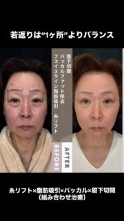 糸リフト（スレッドリフト）＋フェイスライン脂肪吸引＋バッカルファット除去＋眉下切開
「小顔」と「目元」を同時に整える“組み合わせ若返り”の症例経過です。
（正面・両斜め｜術後1週間／1ヶ月）

なるほど：若返りが難しい理由は「1ヶ所だけ治してもバランスが残る」こと

下顔面のもたつきだけ取っても、目元が重いと年齢感が残る。
逆に、目元だけ軽くしても、輪郭の重さが残る。
だから私は、必要がある場合に限り
引き上げ × ボリューム調整 × 目元の皮膚を“顔全体の比率”で組み立てます。

今回の設計（考え方）
糸リフト：たるみ方向を考えて“引き上げの土台”を作る
フェイスライン脂肪吸引：下顔面の重さを「取りすぎず」整える
バッカルファット除去：もたつきの原因が“奥の脂肪”のときに適量調整
眉下切開（眉下リフト）：上まぶたのかぶさりを整えて目元を軽く

経過の見方（ここ大事）
1週間は腫れ・むくみが残りやすい時期。
1ヶ月は途中経過で、そこからさらに落ち着いていくことが多いです（個人差あり）。

施術情報
施術名：糸リフト（スレッドリフト）、フェイスライン脂肪吸引、バッカルファット除去、眉下切開（眉下リフト／眉毛下皮膚切除術）
主なリスク：腫れ、内出血、痛み、感染、左右差、凹凸感/つっぱり感、しびれ・感覚の違和感、瘢痕（傷跡）、希望通りにならない可能性、修正が必要となる可能性 等
費用：範囲・術式・麻酔等で異なります（料金表またはカウンセリングでご案内）

「自分も組み合わせが必要？」「どれを優先？」は、骨格と脂肪のつき方で答えが変わります。
👉ご相談は 「小顔＋眉下（組み合わせ）」 とDM/予約時に一言ください。保存推奨📌

#糸リフト
#フェイスライン脂肪吸引
#バッカルファット除去
#眉下切開
#若返り治療