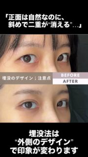 二重埋没法（埋没法）のデザインで、いちばん差が出るのは

「正面の幅」よりも、実は “外側の二重幅” です。

なぜなら——

人は鏡（正面）だけじゃなく、会話中・写真・ふとした瞬間など、斜め45°で見られる時間の方が長いから。

このとき外側のラインが弱いと、正面は良いのに斜めで物足りない印象になりやすいです。

なるほど①：外側は“作る”というより「設計する」

外側は皮膚の動きや厚みの影響を受けやすいので、
「幅を広げれば綺麗」ではなく、残す幅・広げ方・終点をセットで考えます。

なるほど②：外側だけ広い二重は、正面で不自然になりやすい

外側を急に広げると、正面で“やった感”が出たり、左右差が目立つことがあります。
だから私は、正面は自然／斜めで綺麗に幅が見えるバランスに寄せてデザインします。

なるほど③：“終点”が変わると、印象が一気に変わる

二重ラインは「どこまで入れるか」で自然さが決まります。
目尻側は、不自然に伸ばさず、自然に消える位置を狙うのがコツです。

こんな方は「外側デザイン」の相談価値が高いです
・正面は良いのに、斜めで二重が弱い
・平行寄せにしたいけど、やりすぎは避けたい
・写真で、目尻側がのっぺり見えるのが気になる

施術名：二重埋没法
主なリスク：腫れ、内出血、痛み、感染、左右差、糸の露出/しこり感、希望通りにならない可能性、ラインの消失（戻り）、再施術・抜糸が必要となる可能性 など
費用：方法・点数・保証の有無等で異なります（料金表またはカウンセリングでご案内）モニター価格税込110,880円〜

「自分の外側は残せる？」「どこまでが自然？」は、まぶたの厚み・骨格・目の開きで答えが変わります。
👉公式LINE/DMの一言は 「埋没デザイン相談（外側）」 でOKです。
保存して、カウンセリング前のメモにしてください📌

#埋没法 #二重埋没 #埋没デザイン #二重デザイン #二重幅 #平行二重 #末広二重
#目尻 #外側の二重 #まぶたの厚み #左右差 #ダウンタイム #埋没取れた
#美容外科 #美容医療 #カウンセリング #症例写真
#doubleeyelidsurgery #nonincisional #eyelidsurgery