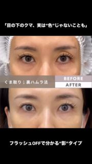 目の下のクマ治療｜裏ハムラ（経結膜・脂肪再配置）の症例動画です。
今回は正面の瞬きだけ。
フラッシュOFFで、クマ（特に“影”）が認識できる条件で撮影しています。
クマって「色素（茶クマ）」と思われがちですが、実際は
光と影（黒クマ）＝ふくらみ＋溝の段差が原因のケースもあります。
瞬きで影が強調される方は、まさにこのタイプのことがあります。

裏ハムラの考え方
裏ハムラは、目の下の脂肪を“取る”のではなく、移動して段差をならす治療。
段差がなだらかになると、影が薄く見えやすくなり、疲れて見える印象の軽減を狙えます（個人差あり）。

全員に最適とは限りません
皮膚のたるみ・小ジワが強い場合は、裏ハムラ単独より別治療（追加治療）が適することも。
なので私は、まずクマの原因（影／色／血行／たるみ）を整理してから、方法を提案します。

施術情報
施術名：裏ハムラ法（経結膜下眼瞼・脂肪再配置）
主なリスク：腫れ、内出血、痛み、感染、左右差、凹凸/しこり感、違和感、希望通りにならない可能性、修正が必要となる可能性 等
費用：術式・範囲・麻酔等で異なります（料金表またはカウンセリングでご案内）

👉ご相談はDM/予約時に 「裏ハムラ相談」 と一言ください。保存して見返せるように📌

#裏ハムラ
#目の下のクマ
#クマ取り
#目の下のたるみ
#脂肪再配置